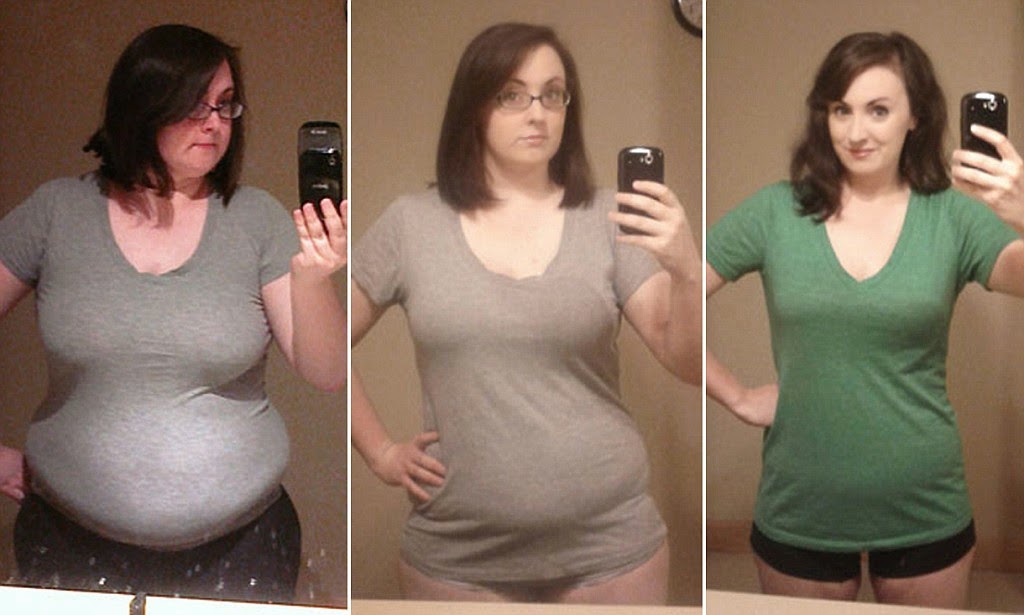 Extreme Weight Loss Weight Loss Transformations Weight Loss Terms