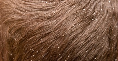 Secret of Health: Dandruff