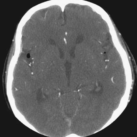Mri Brain: Flow Voids Mri Brain
