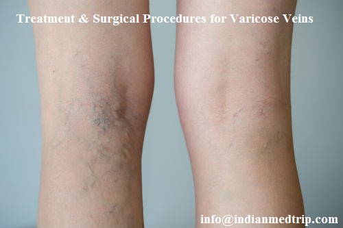 Treatment & Surgical Procedures for Varicose Veins