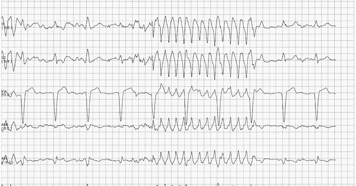 Float Nurse Movement artifact