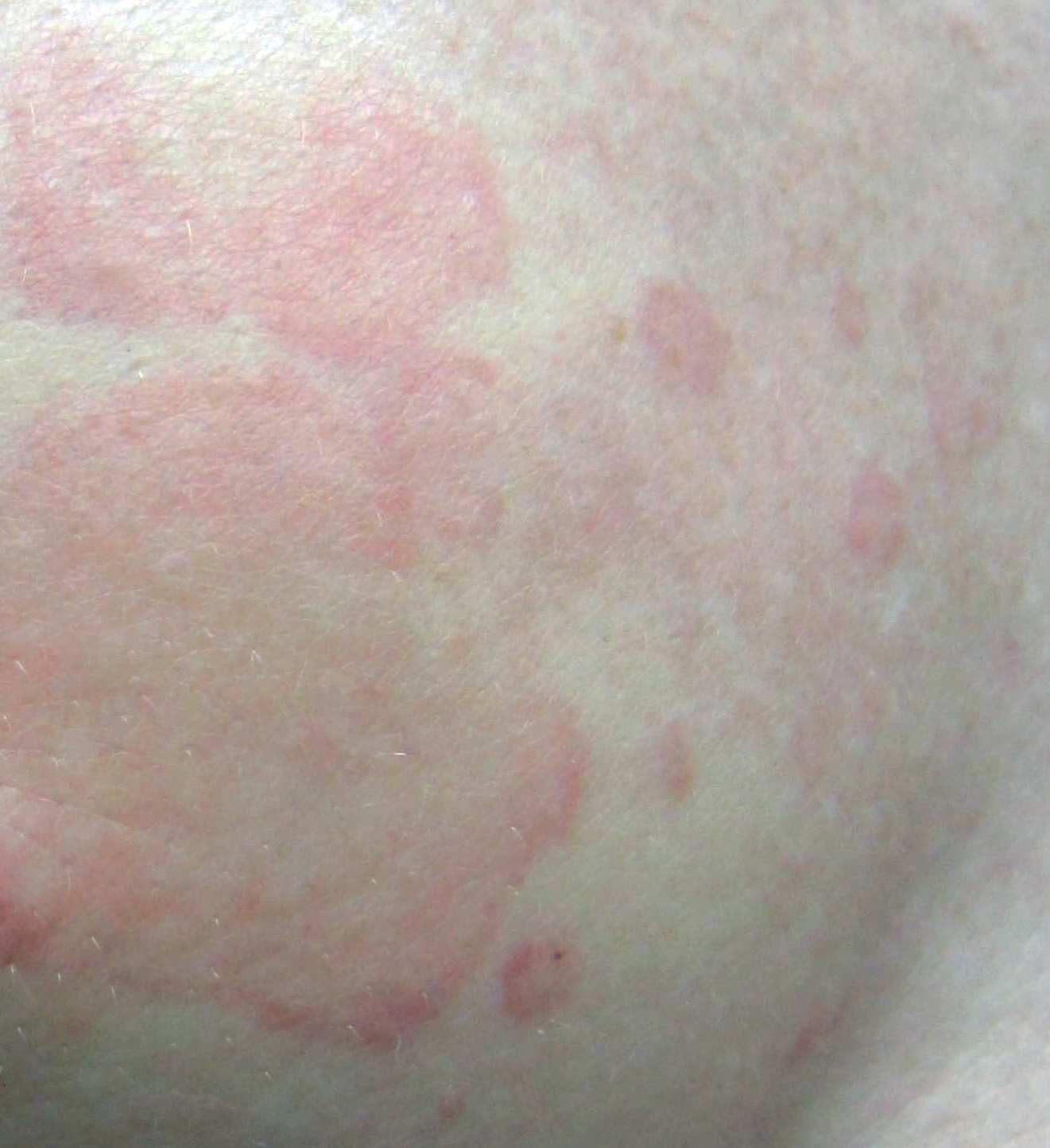 Blotchy Rash On Neck And Chest - Doctor answers on HealthTap