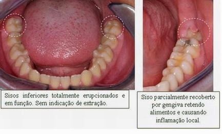 Sintomas Do Dente Do Siso Nascendo