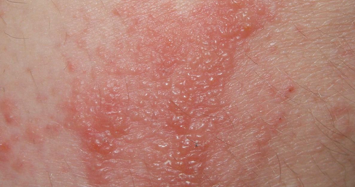 Allergie: manuale per i pazienti - Dr. Nicola Verna: La Dermatite da ...