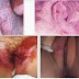 Muncul Luka Yang Menyerang Daerah Vagina