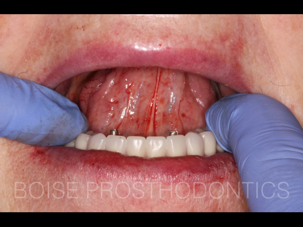 Boise Idaho Prosthodontics Immediate Load Implant Prosthesis Hybrid