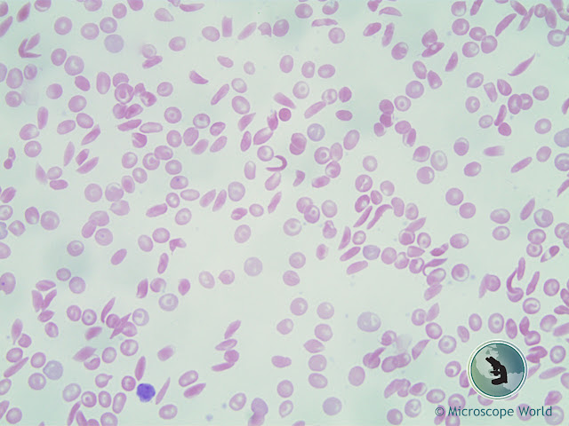 Microscope World image of sickle cell anemia captured at 400x.