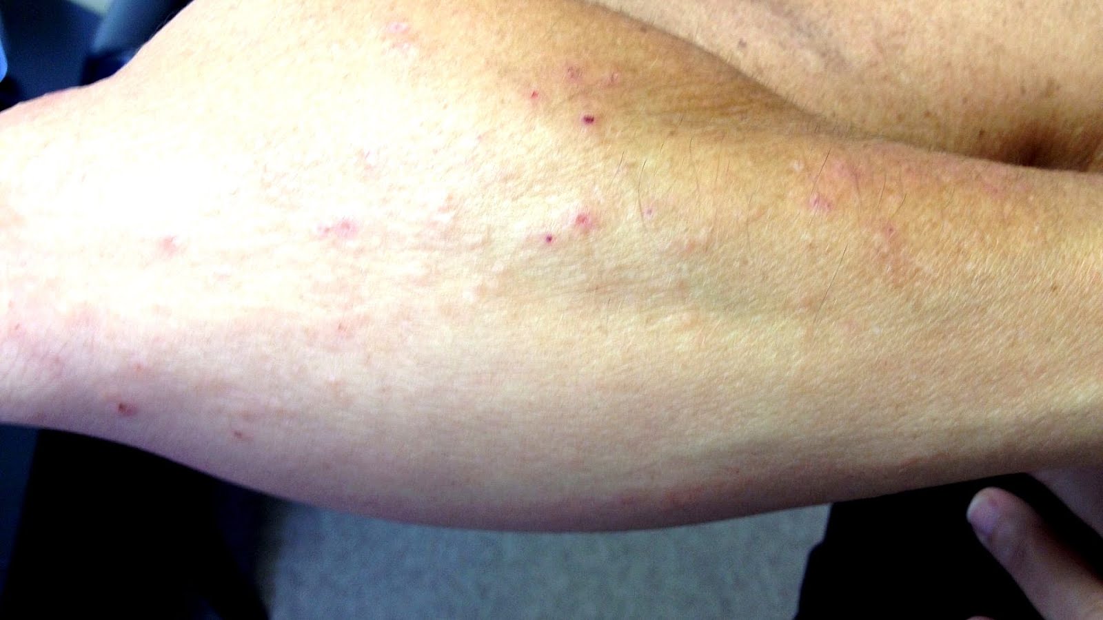 Cetirizine Zyrtec Effects Effect Choices