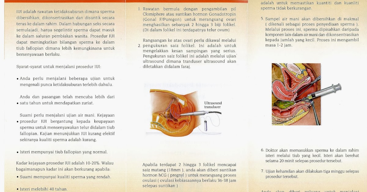 Syok Sendiri II: Prosedur IUI di HKL + cara inject hormon.