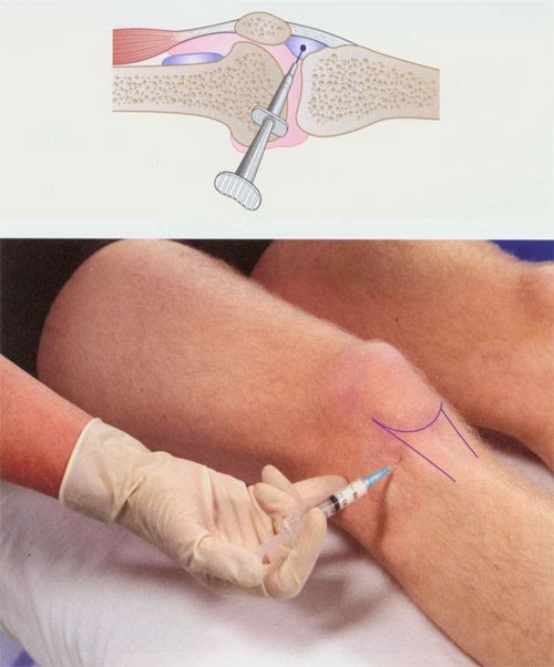 InfraPatellar Bursa Injection ~ Nursing