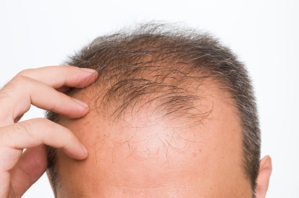 Iron Deficiency Could Causes Hair Loss Healthfame Com