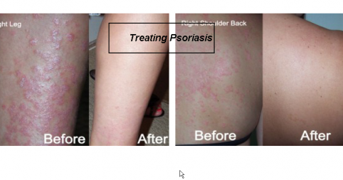 kangen psoriasis