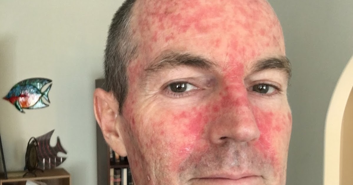 Efudix Treatment Day 12 9 days left!