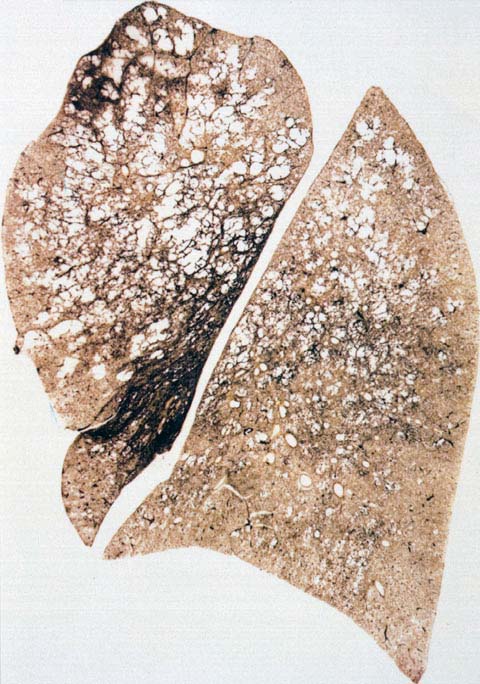 Centriacinar Centrilobular Emphysema Medicine Hack centriacinar-centrilobular-emphysema-medicine-hack