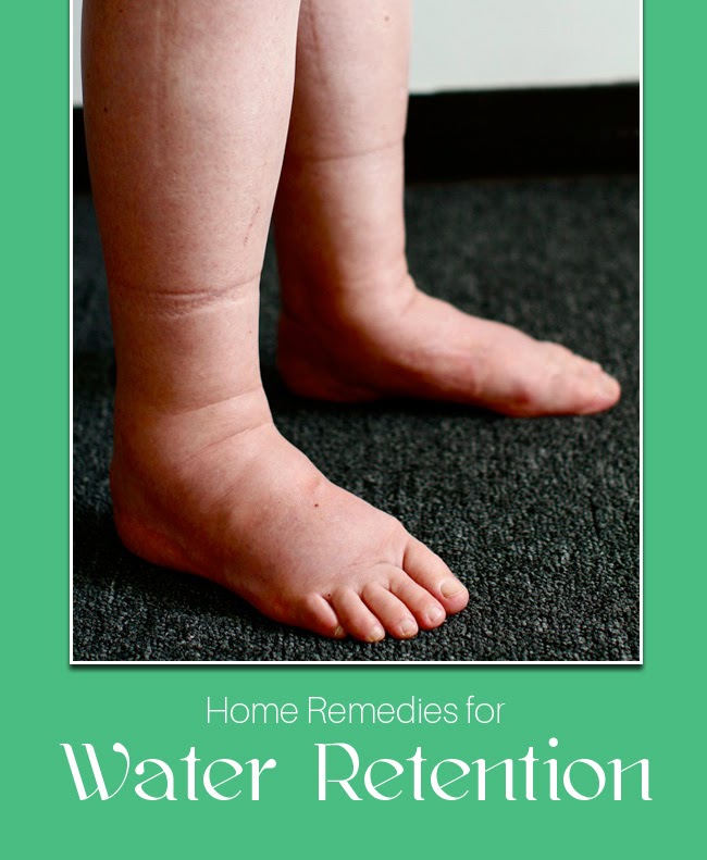 Home Remedy For Water Retention Edema Medi Tricks