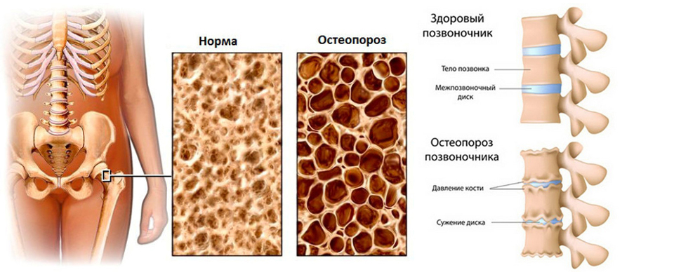 El mejor alimento para la osteoporosis