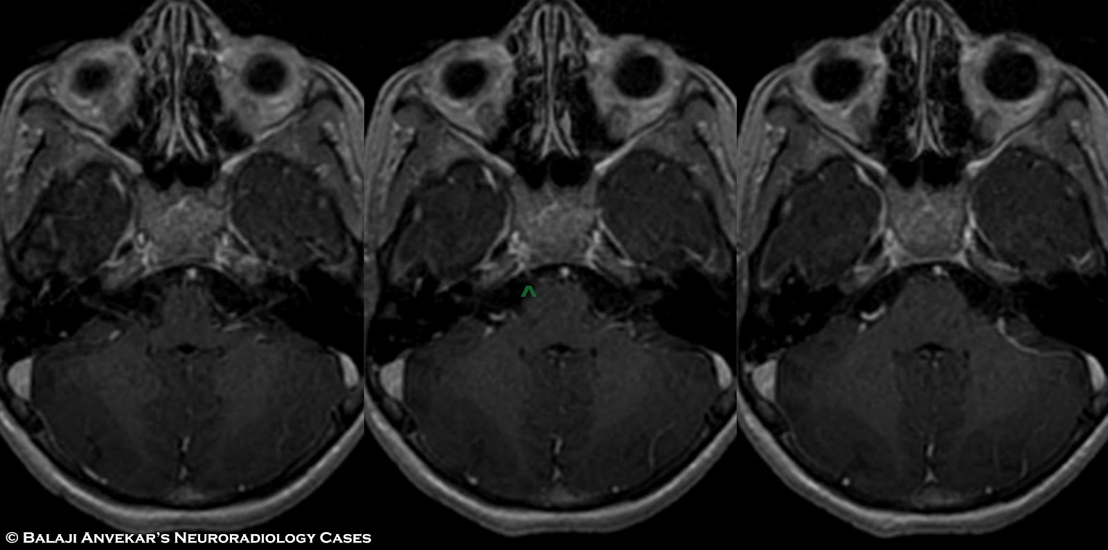 Mri Brain Fiesta Mri Brain