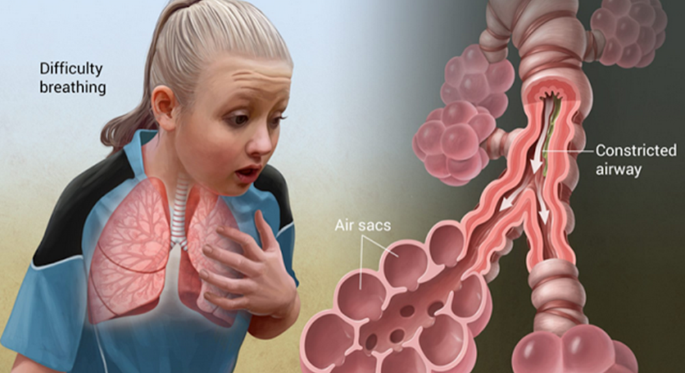 Antagonis Receptor Leukotrien