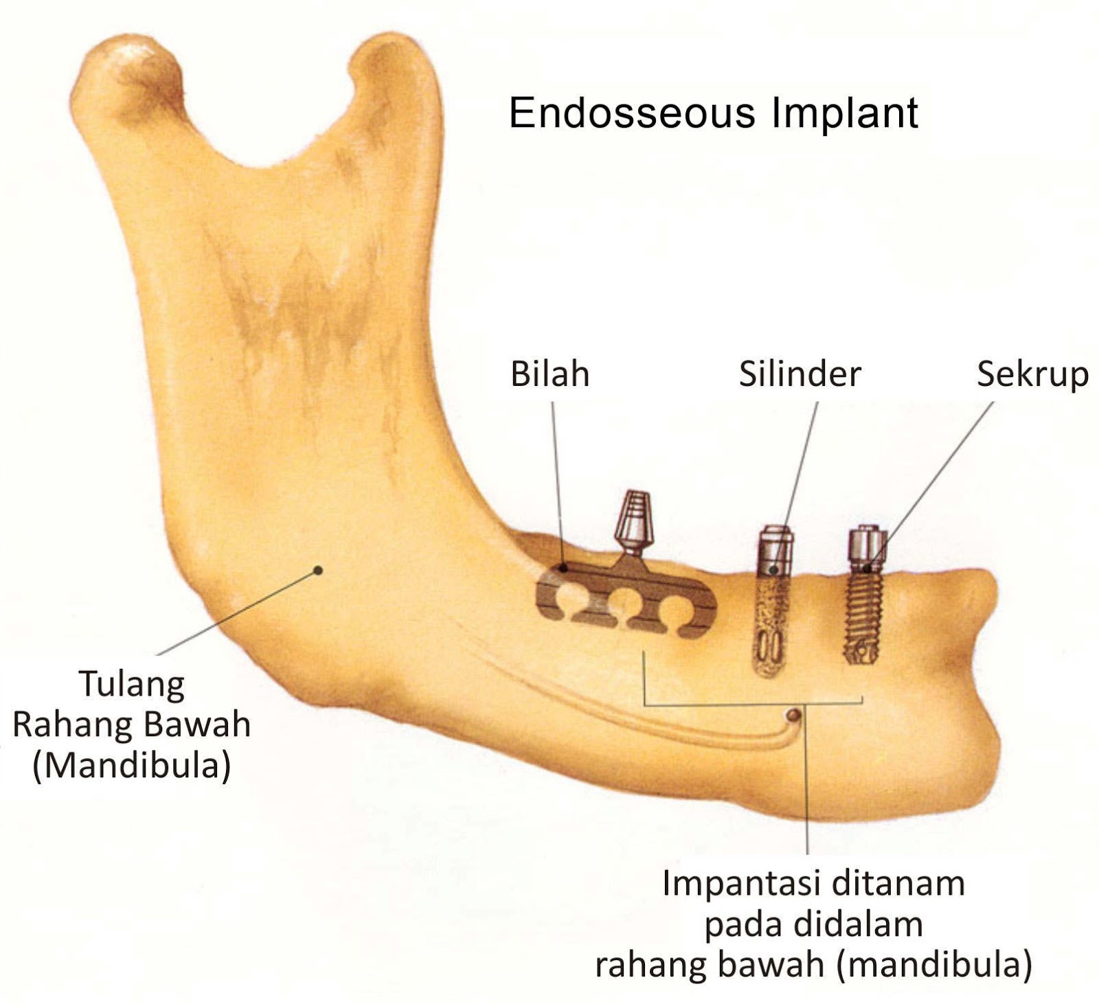 Implan Gigi (Gigi Palsu, Gigi Tiruan) Pengganti Gigi Asli Patah/Ompong