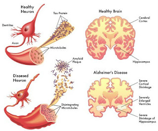 how cure alzheimers and dementia in early stages,stages of alzheimers,symptoms of alzheimers