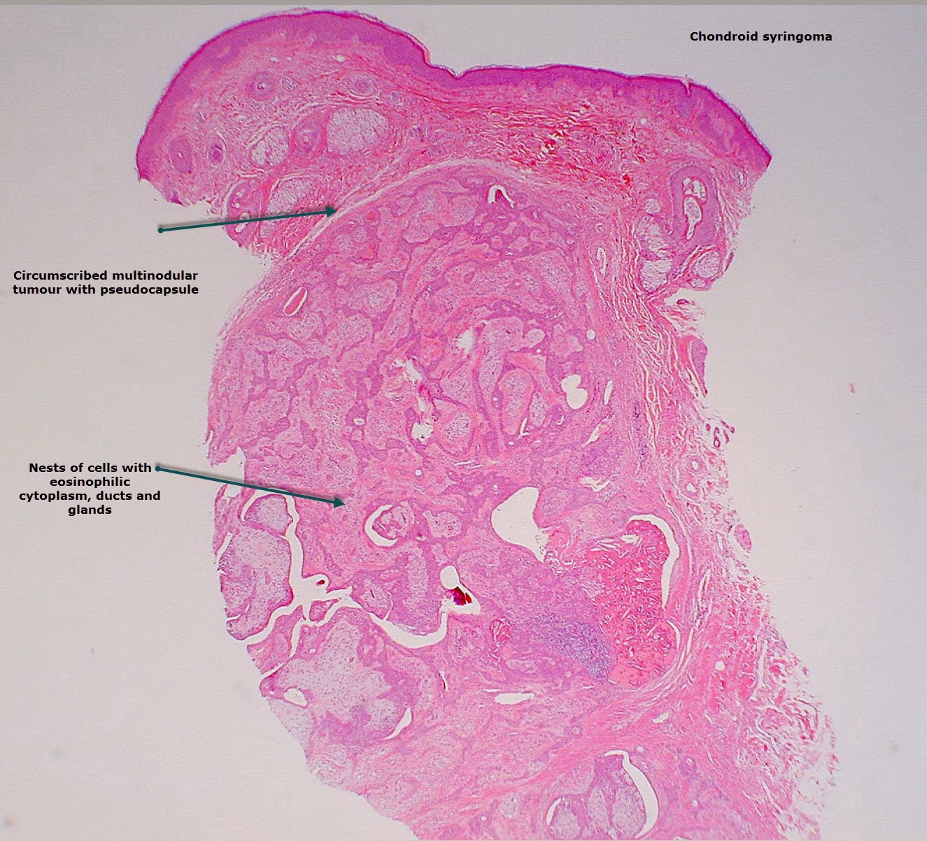 Sweat Gland Cancers Rare but on the Rise - WebMD