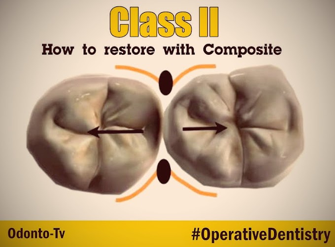 COMPOSITE RESTORATION: How to restore the difficult Class II with Composite - CLINICAL CASE