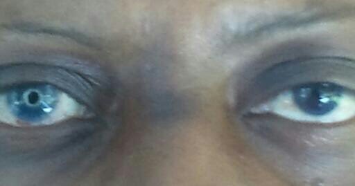 During and After the "Keratoconus Blur" Keratoconus Group During and After the "Keratoconus Blur" Keratoconus Group