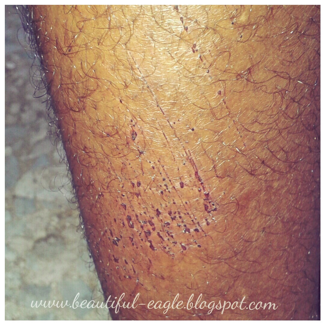 leg hairy accident bruise chit lessons chat yup recent