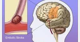 emboli embolism classification fate clinical manifestations emboli embolism classification fate clinical manifestations