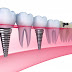 Phòng ngừa viêm chân răng implant cần chú ý