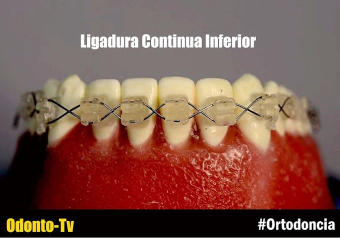 ORTODONCIA: Ligadura Continua Inferior - Ortocervera
