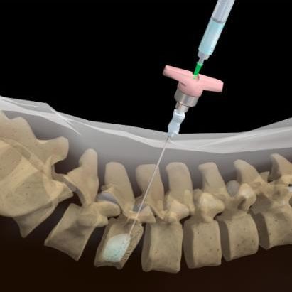 Vertebroplasty and Kyphoplasty Devices Market Vertebroplasty and Kyphoplasty Devices Market