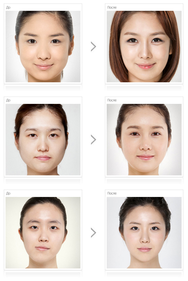 Операция по изменению формы. Типичная внешность китаянки. Операция по изменению формы. Пластика азиатских век. Операция по изменению формы.