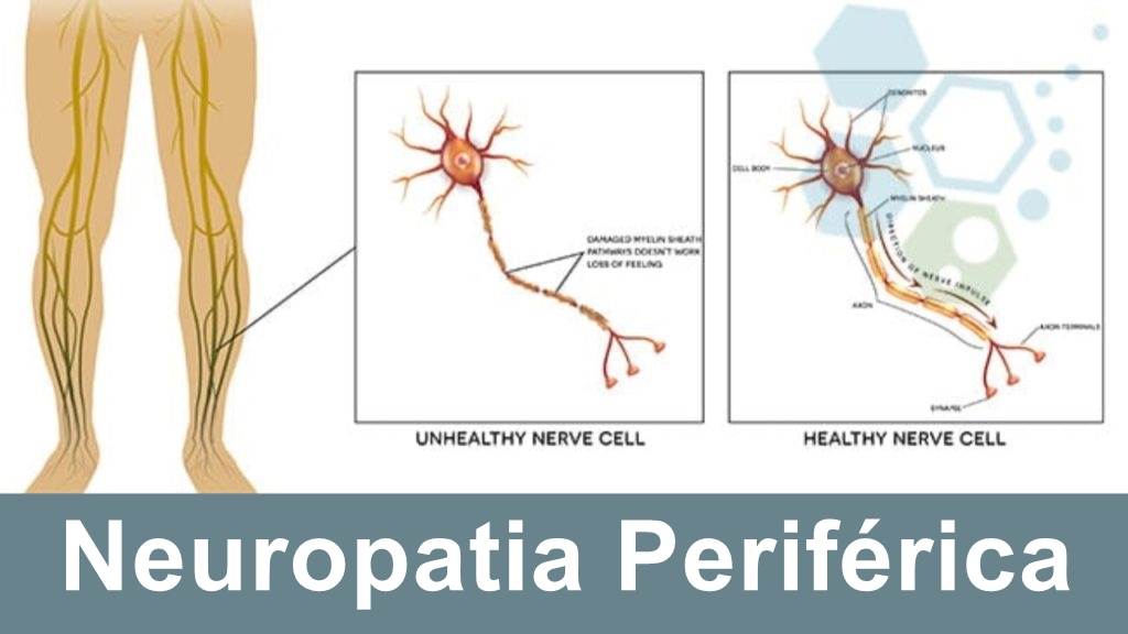Melhores Opções de Tratamento Natural Para Neuropatia Periférica