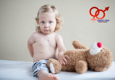chickenpox in children, health insight, life insurance chickenpox in children, health insight, life insurance