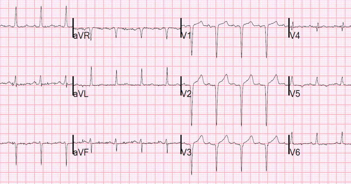 Dr. Smith's ECG Blog: ST elevation and QS-waves. ECG is 