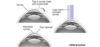 Lasik smile surgery in India 