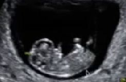 10 haftalık gebelik ultrason görüntüleri
