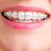 Niềng răng sứ - Hai loại phổ biến