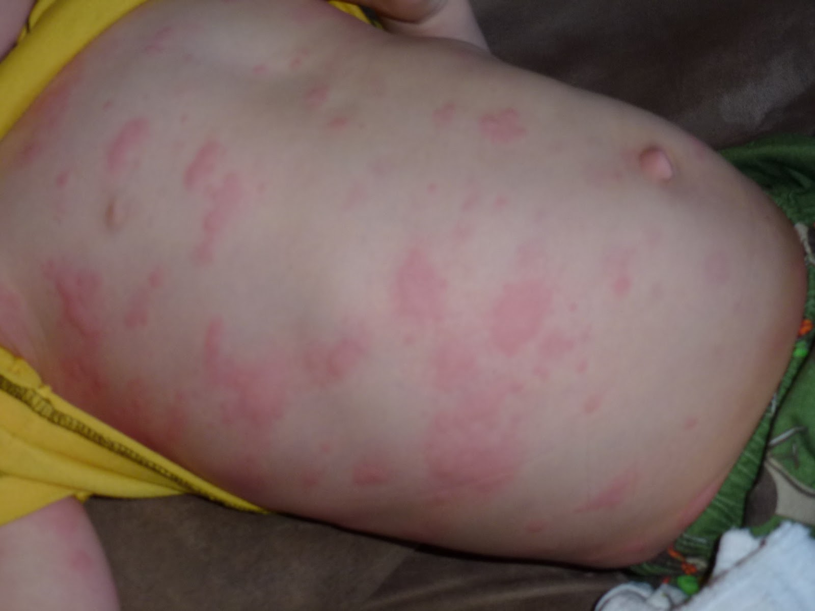 viral rashes in toddler