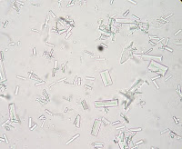 Struvite crystals in urine