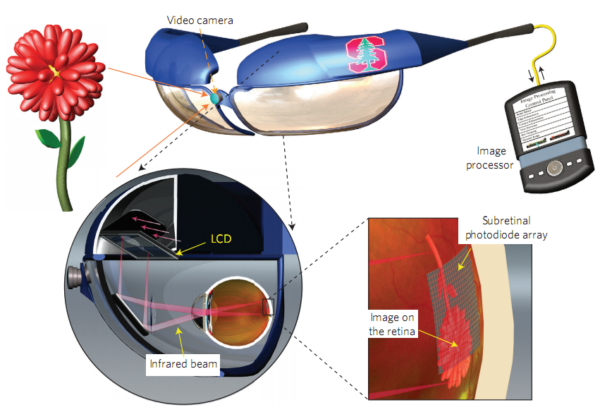 Beta Blog Eye implant with lasers restores vision in blind people
