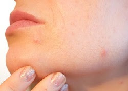 How to Get Rid of Acne Scar for Good