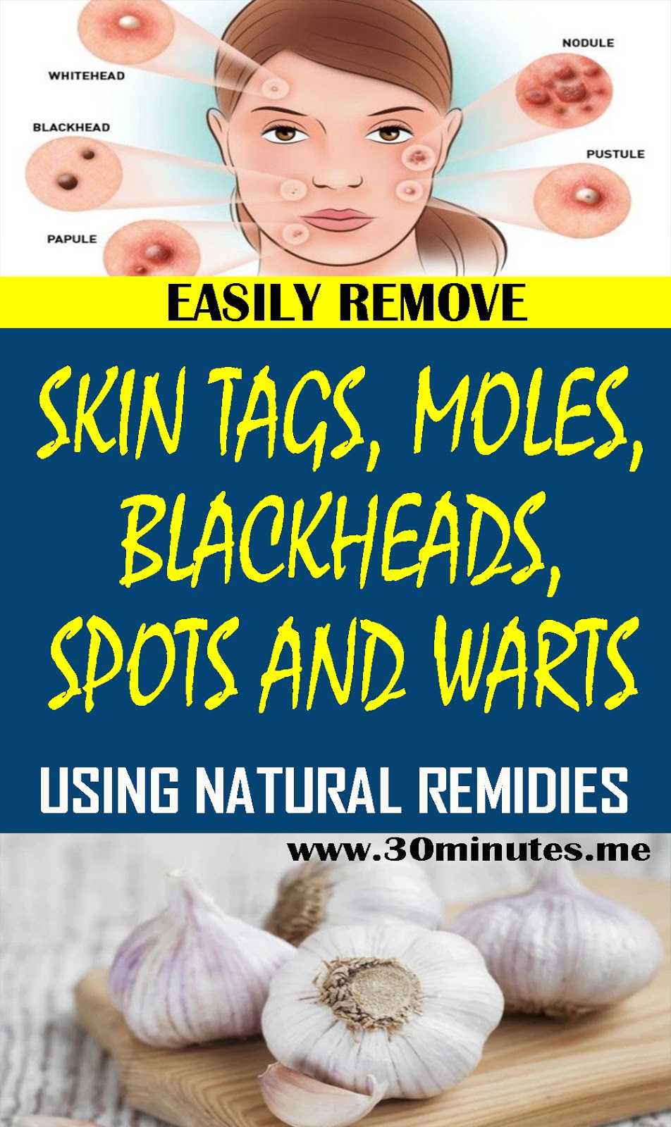 How To Get Rid Of Skin Tags And Moles Naturally HOW TO EASILY REMOVE SKIN TAGS, MOLES, BLACKHEADS, SPOTS AND WARTS BY