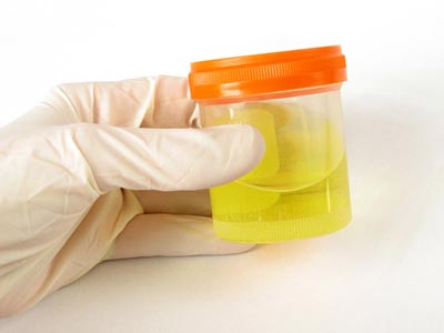 urina incolora urinari dese supozitoare pentru prostatita forum