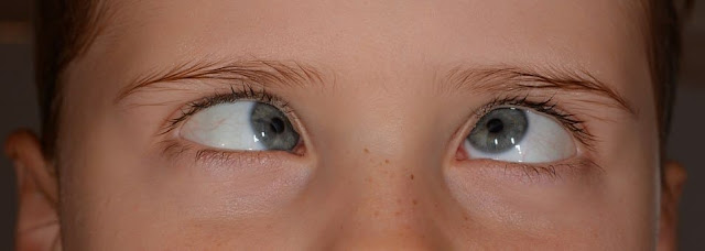 Strabismus (crossed eyes) - Cause and Treatment