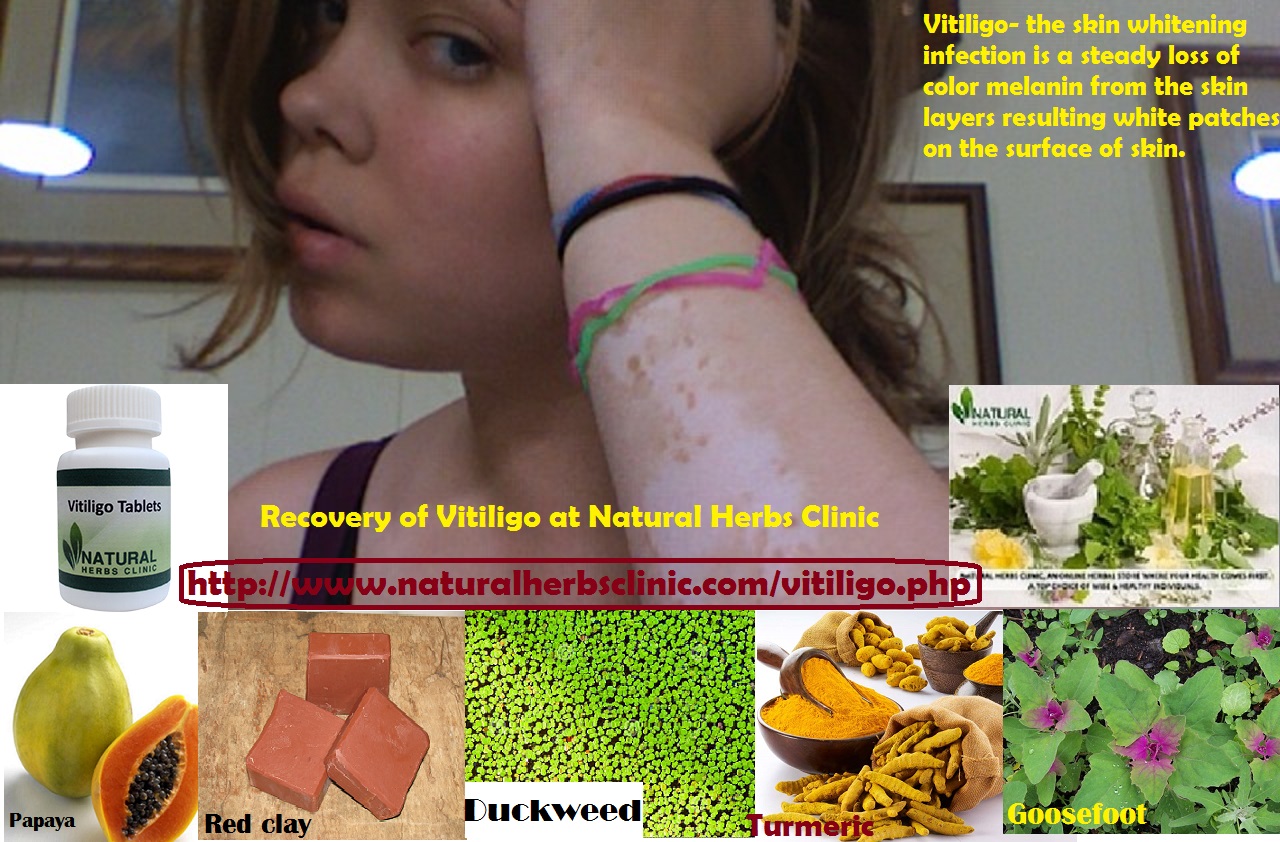 Vitiligo Overview Recovery of Vitiligo at Natural Herbs Clinic with