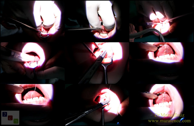 Tongue tie release surgery with thermal welding device - Lingual frenectomy operation with thermal welding device - Bloodless and knifeless tongue tie release surgery - Bloodless lingual frenectomy with with thermal welding – Tongue tie treatment in İstanbul, Turkey