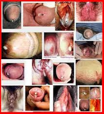 Lubang Penis Mengeluarkan Cairan Nanah Serta Nyeri Ketika Kencing Lubang Penis Mengeluarkan Cairan Nanah Serta Nyeri Ketika Kencing