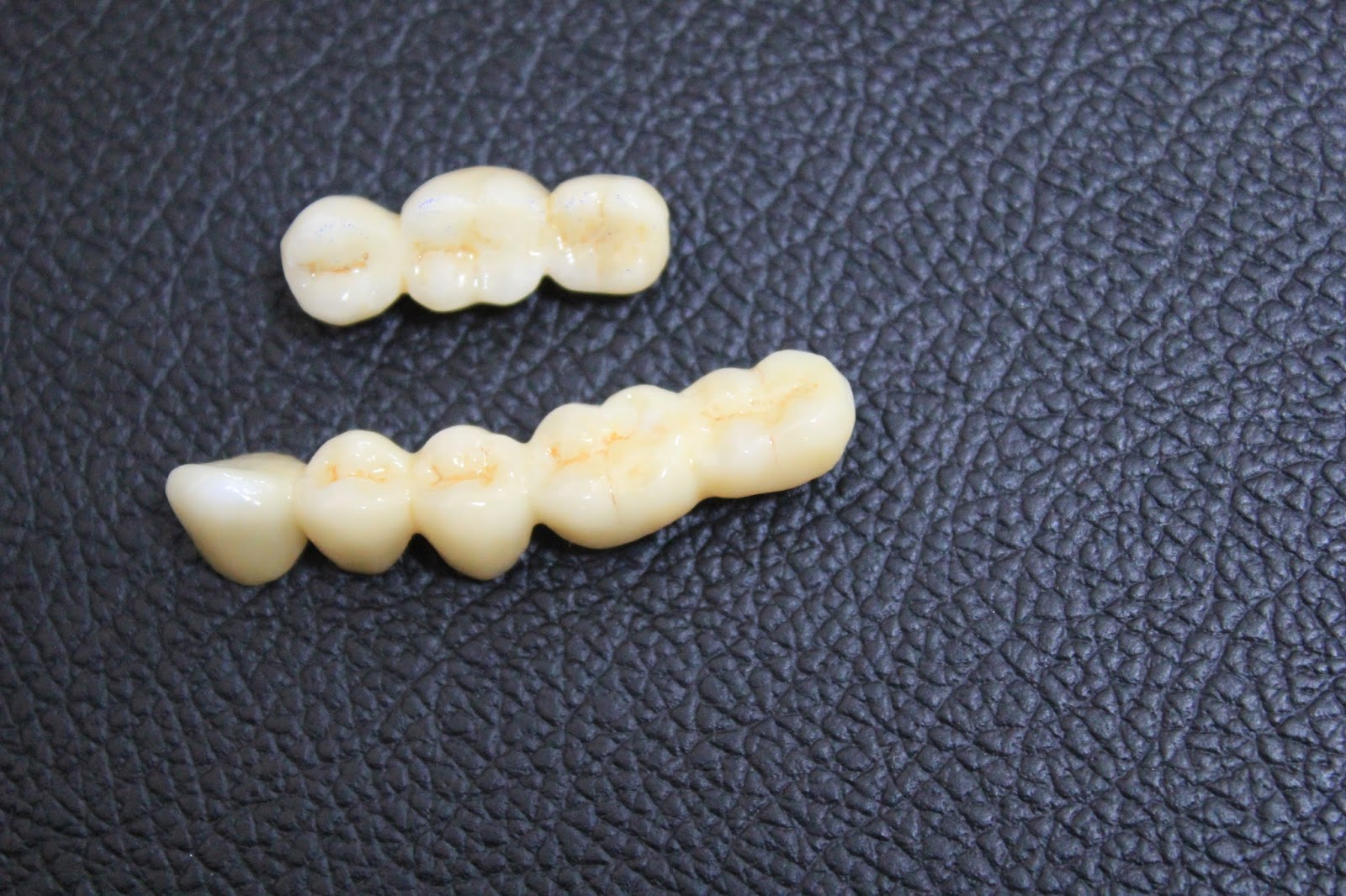 Zirconium bridges for teeth replacement with dental implants.